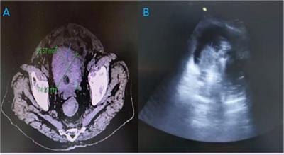 Removal of large fibrotic bladder blood clots using prostatic tissue morcellator under real-time ultrasound guidance